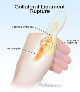 ulnar_collateral_rupture